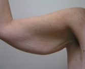 Feel Beautiful - Arms 1 - Before Photo
